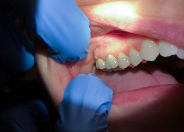 Best Emergency Denture Repair in Aspermont, TX