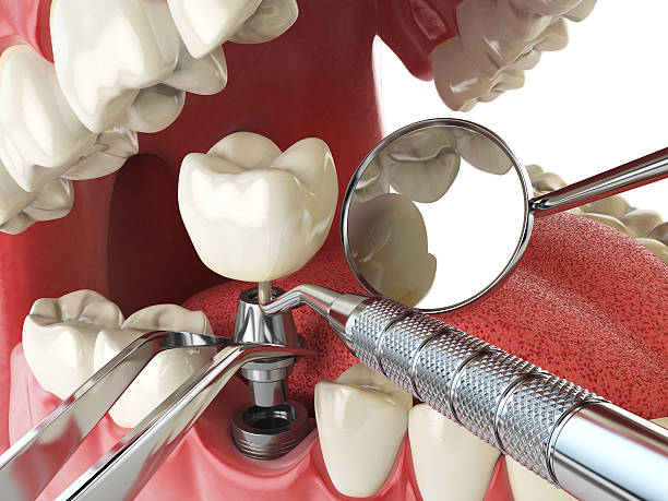 Best Emergency Tooth Extraction in Aspermont, TX